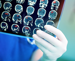       Brain Health - Keeping us Safe from Disabling Stroke   
